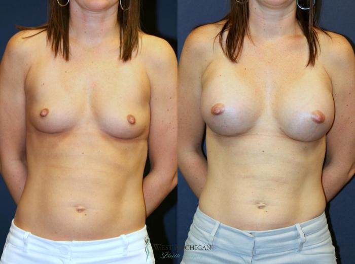 Before & After Breast Augmentation Case 9101 View #1 View in Portage, Kalamazoo, Battle Creek, Michigan