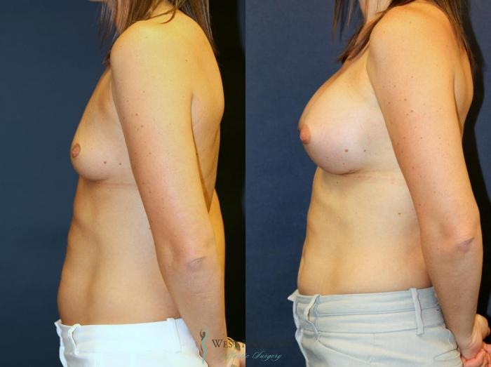 Before & After Breast Augmentation Case 9101 View #2 View in Portage, Kalamazoo, Battle Creek, Michigan