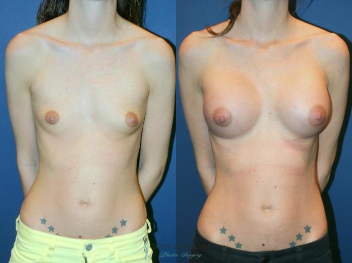 Before & After Breast Augmentation Case 9104 View #1 View in Kalamazoo & Grand Rapids, Michigan