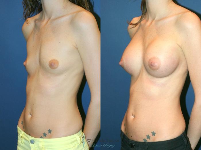 Before & After Breast Augmentation Case 9104 View #3 View in Kalamazoo & Grand Rapids, Michigan