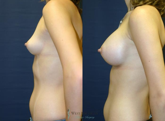 Before & After Breast Augmentation Case 9105 View #2 View in Kalamazoo & Grand Rapids, Michigan