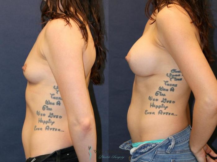 Before & After Breast Augmentation Case 9106 View #2 View in Portage, Kalamazoo, Battle Creek, Michigan