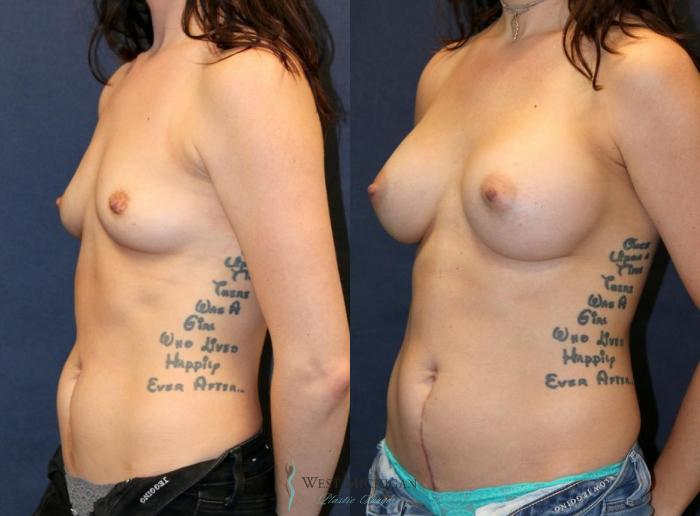Before & After Breast Augmentation Case 9106 View #3 View in Portage, Kalamazoo, Battle Creek, Michigan