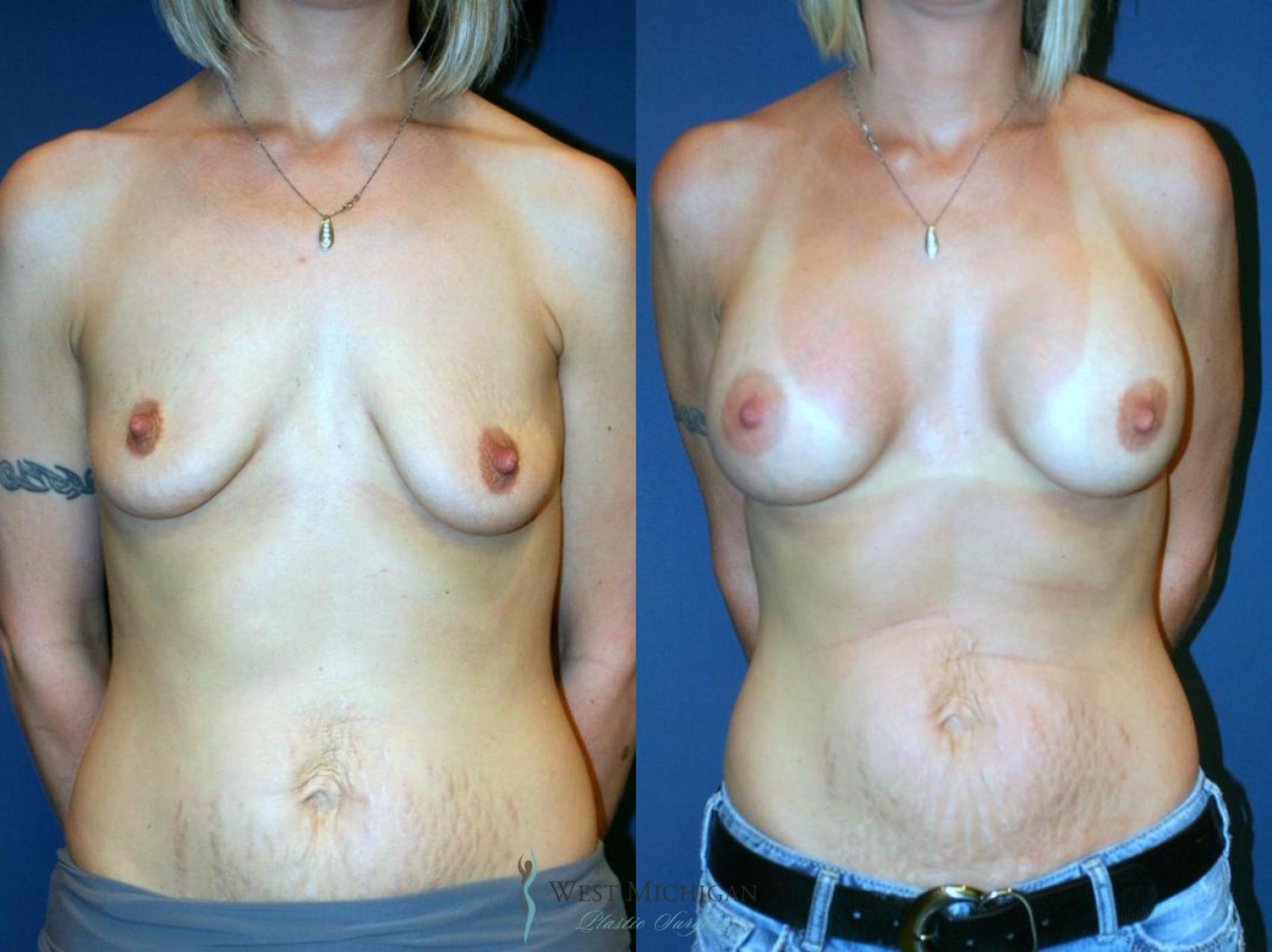 Before & After Breast Augmentation Case 9107 View #1 View in Portage, Kalamazoo, Battle Creek, Michigan