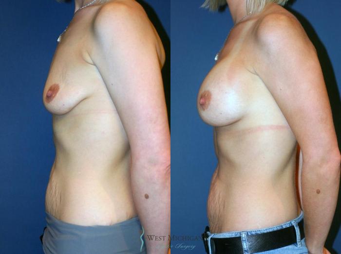 Before & After Breast Augmentation Case 9107 View #2 View in Portage, Kalamazoo, Battle Creek, Michigan