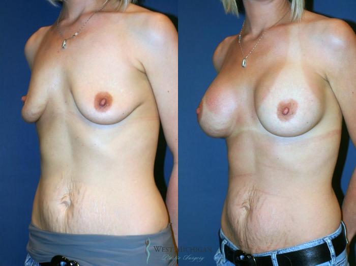Before & After Breast Augmentation Case 9107 View #3 View in Portage, Kalamazoo, Battle Creek, Michigan