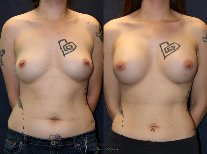 Before & After Breast Augmentation Case 9108 View #1 View in Portage, Kalamazoo, Battle Creek, Michigan