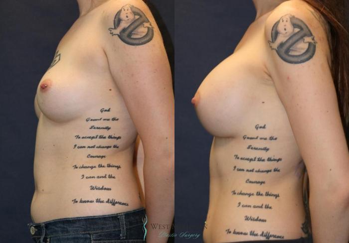 Before & After Breast Augmentation Case 9108 View #2 View in Portage, Kalamazoo, Battle Creek, Michigan