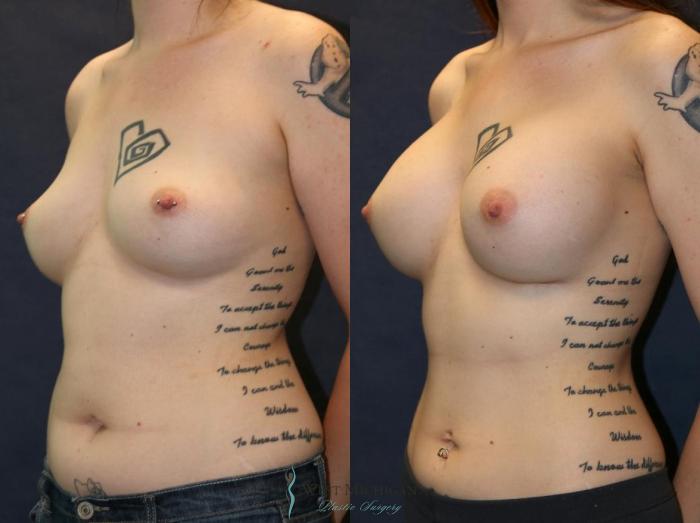 Before & After Breast Augmentation Case 9108 View #3 View in Portage, Kalamazoo, Battle Creek, Michigan