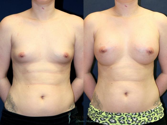 Before & After Breast Augmentation Case 9111 View #1 View in Portage, Kalamazoo, Battle Creek, Michigan