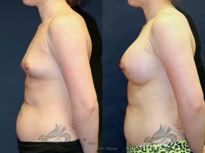 Before & After Breast Augmentation Case 9111 View #2 View in Portage, Kalamazoo, Battle Creek, Michigan