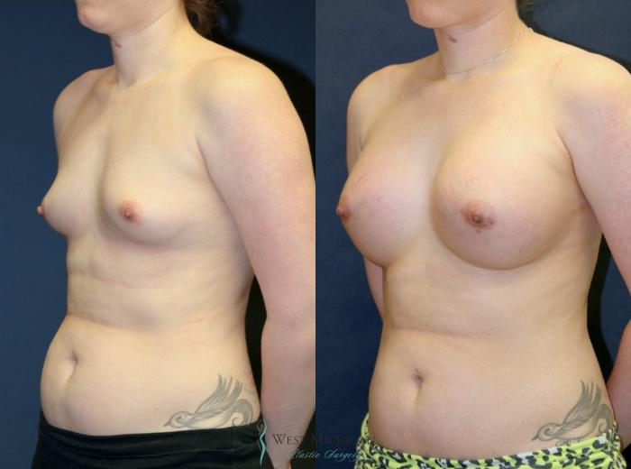 Before & After Breast Augmentation Case 9111 View #3 View in Portage, Kalamazoo, Battle Creek, Michigan