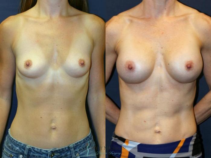 Before & After Breast Augmentation Case 9112 View #1 View in Portage, Kalamazoo, Battle Creek, Michigan