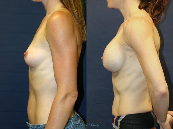 Before & After Breast Augmentation Case 9112 View #2 View in Portage, Kalamazoo, Battle Creek, Michigan