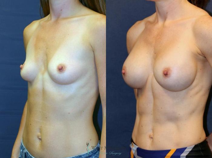 Before & After Breast Augmentation Case 9112 View #3 View in Portage, Kalamazoo, Battle Creek, Michigan