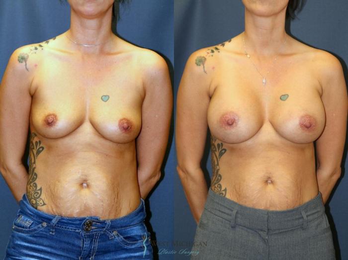 Before & After Breast Augmentation Case 9113 View #1 View in Portage, Kalamazoo, Battle Creek, Michigan