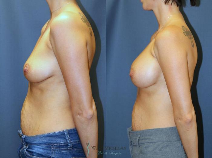 Before & After Breast Augmentation Case 9113 View #2 View in Portage, Kalamazoo, Battle Creek, Michigan