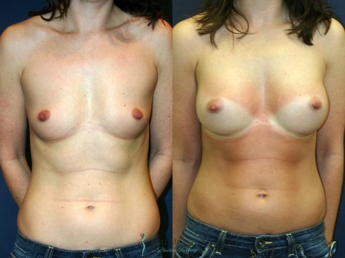 Before & After Breast Augmentation Case 9114 View #1 View in Portage, Kalamazoo, Battle Creek, Michigan