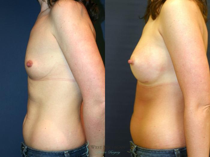 Before & After Breast Augmentation Case 9114 View #2 View in Portage, Kalamazoo, Battle Creek, Michigan