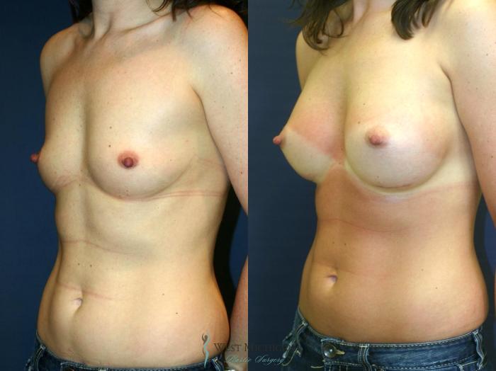 Before & After Breast Augmentation Case 9114 View #3 View in Portage, Kalamazoo, Battle Creek, Michigan