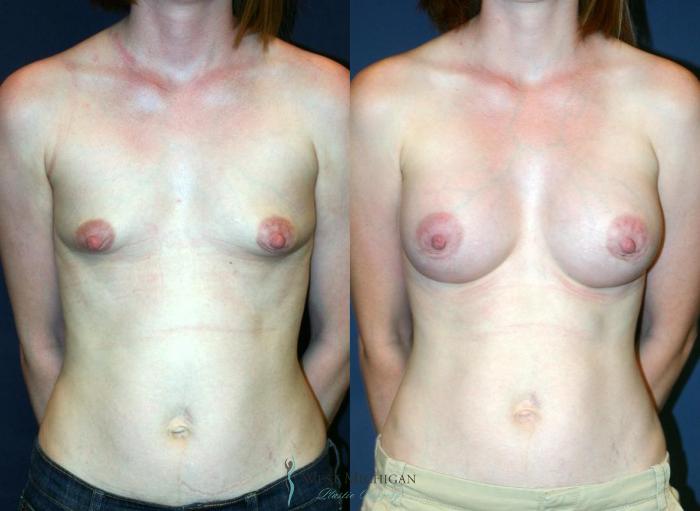 Before & After Breast Augmentation Case 9115 View #1 View in Portage, Kalamazoo, Battle Creek, Michigan