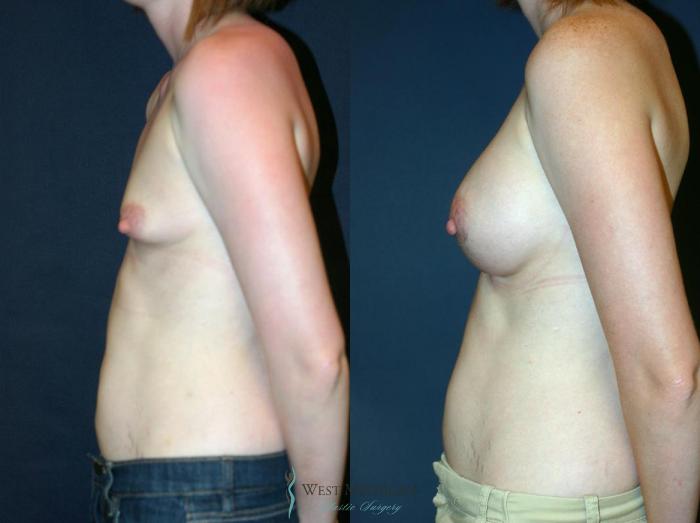 Before & After Breast Augmentation Case 9115 View #2 View in Portage, Kalamazoo, Battle Creek, Michigan