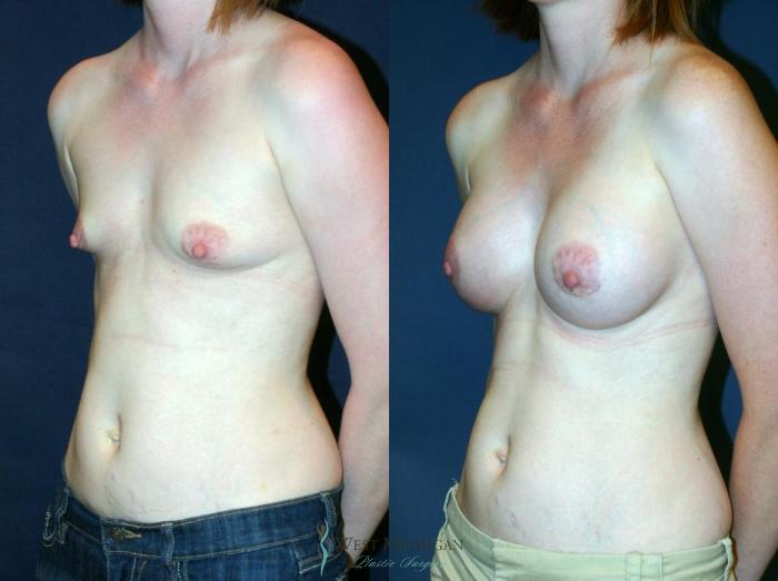 Before & After Breast Augmentation Case 9115 View #3 View in Portage, Kalamazoo, Battle Creek, Michigan