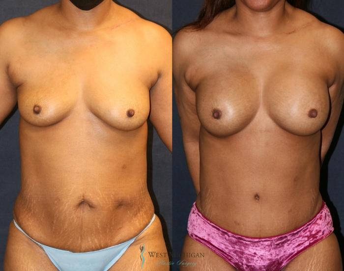 Before & After Breast Augmentation Case 9322 Front View in Portage, Kalamazoo, Battle Creek, Michigan