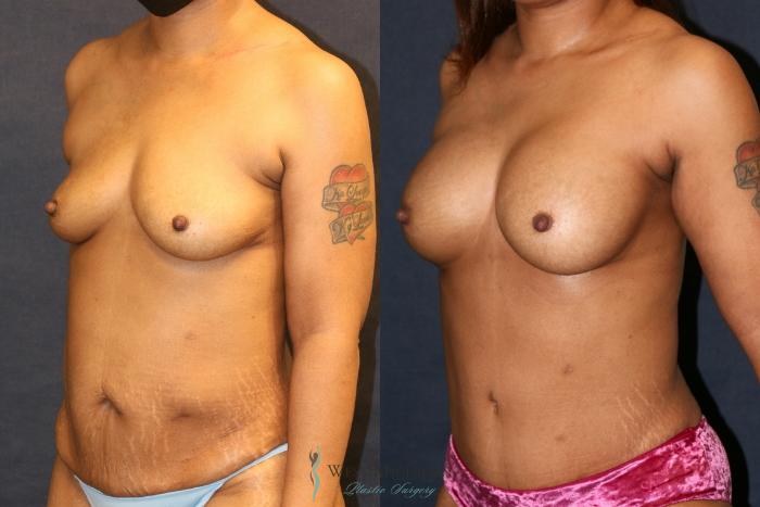 Before & After Breast Augmentation Case 9322 Left Oblique View in Kalamazoo & Grand Rapids, Michigan