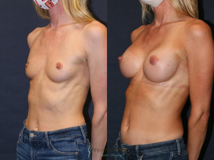 Before & After Breast Augmentation Case 9344 Left Oblique View in Portage, Kalamazoo, Battle Creek, Michigan