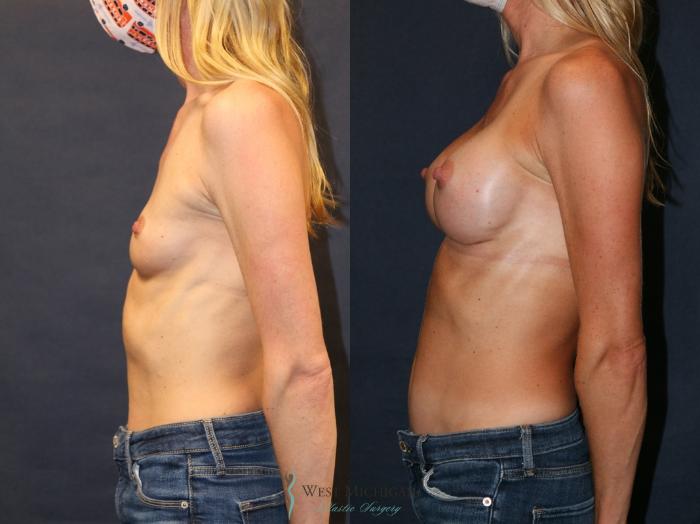 Before & After Breast Augmentation Case 9344 Left Side View in Portage, Kalamazoo, Battle Creek, Michigan