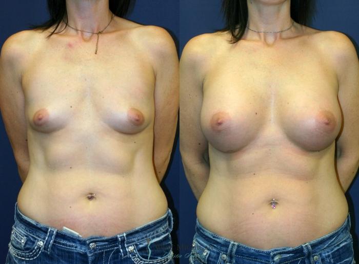 Before & After Breast Augmentation Case 9345 Front View in Kalamazoo & Grand Rapids, Michigan