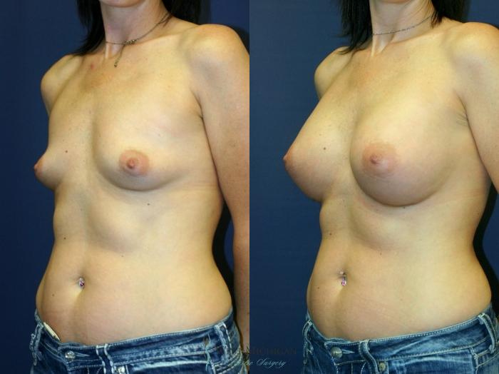Before & After Breast Augmentation Case 9345 Left Oblique View in Kalamazoo & Grand Rapids, Michigan