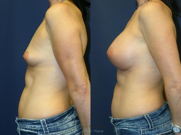 Before & After Breast Augmentation Case 9345 Left Side View in Kalamazoo & Grand Rapids, Michigan
