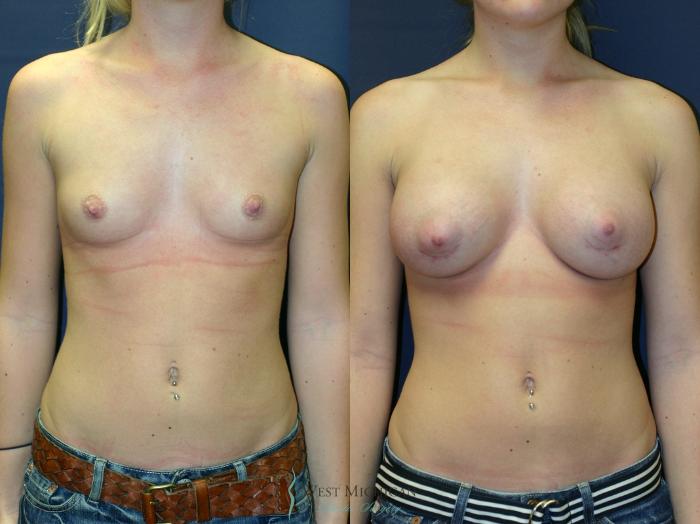 Before & After Breast Augmentation Case 9346 Front View in Portage, Kalamazoo, Battle Creek, Michigan