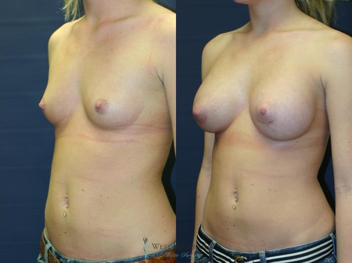 Before & After Breast Augmentation Case 9346 Left Oblique View in Kalamazoo & Grand Rapids, Michigan