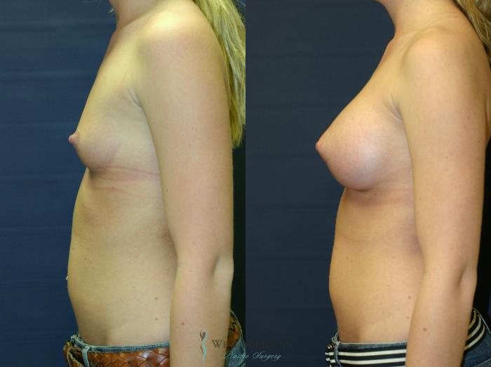 Before & After Breast Augmentation Case 9346 Left Side View in Kalamazoo & Grand Rapids, Michigan