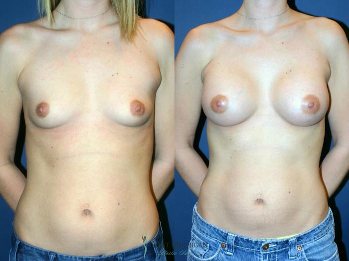 Before & After Breast Augmentation Case 9347 Front View in Portage, Kalamazoo, Battle Creek, Michigan