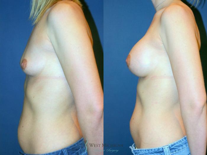Before & After Breast Augmentation Case 9347 Left Side View in Kalamazoo & Grand Rapids, Michigan