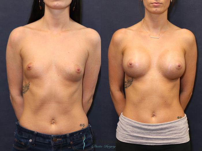 Before & After Breast Augmentation Case 9348 Front View in Kalamazoo & Grand Rapids, Michigan