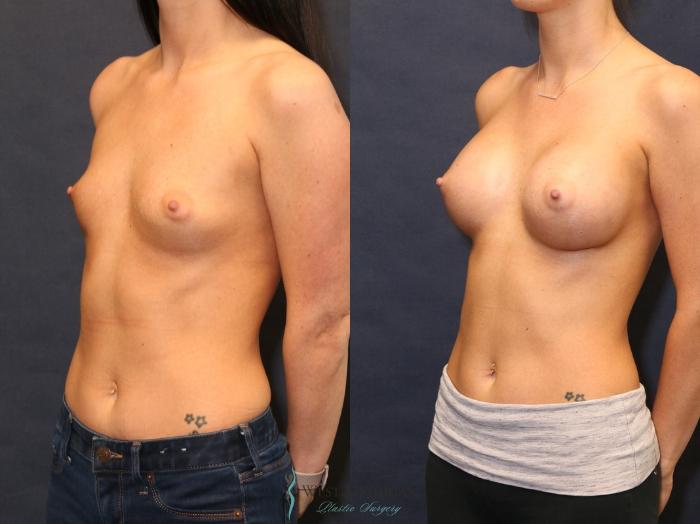 Before & After Breast Augmentation Case 9348 Left Oblique View in Portage, Kalamazoo, Battle Creek, Michigan