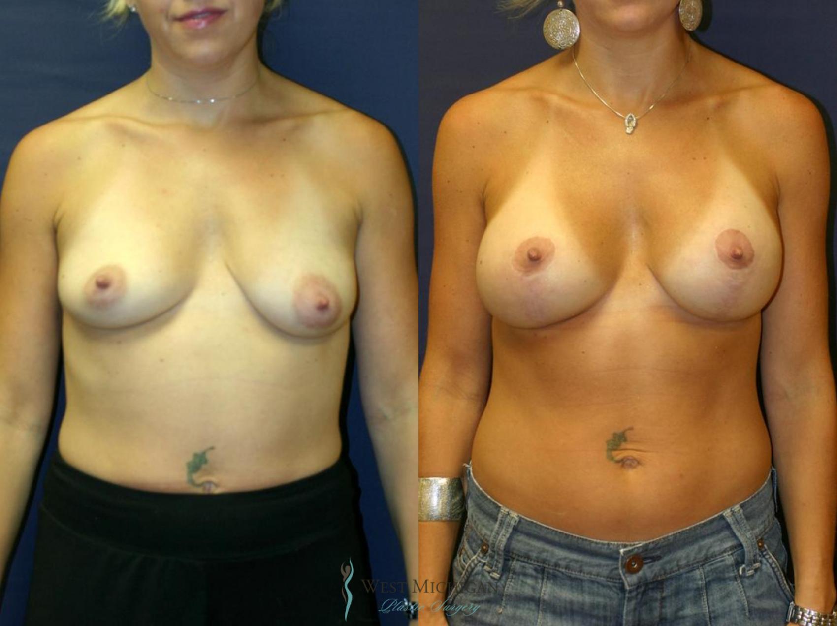 Before & After Breast Augmentation with Lift Case 8719 View #1 View in Portage, Kalamazoo, Battle Creek, Michigan