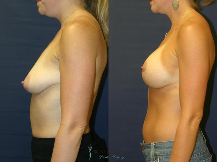 Before & After Breast Augmentation with Lift Case 8719 View #2 View in Portage, Kalamazoo, Battle Creek, Michigan