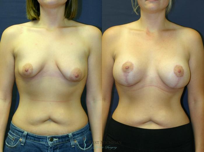 Before & After Breast Augmentation with Lift Case 8907 View #1 View in Portage, Kalamazoo, Battle Creek, Michigan