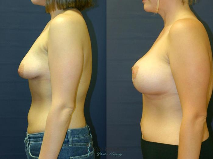 Before & After Breast Augmentation with Lift Case 8907 View #2 View in Portage, Kalamazoo, Battle Creek, Michigan