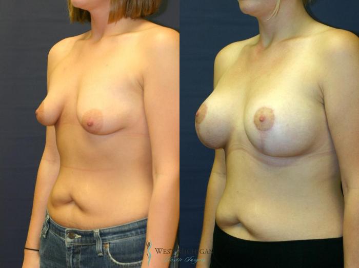 Before & After Breast Augmentation with Lift Case 8907 View #3 View in Portage, Kalamazoo, Battle Creek, Michigan