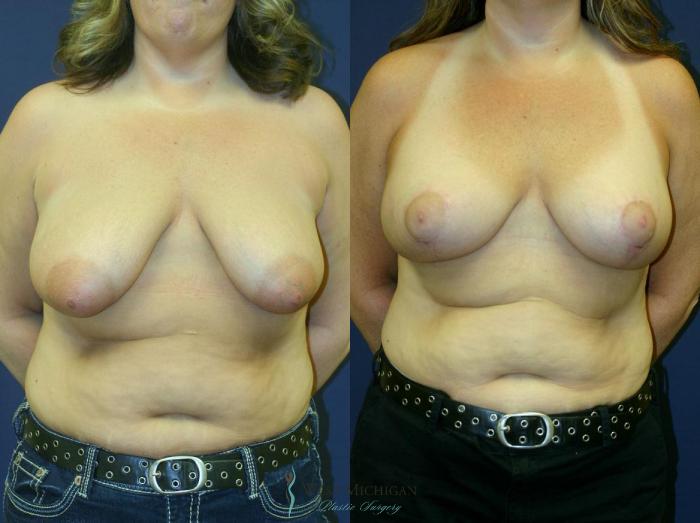 Before & After Breast Augmentation with Lift Case 8908 View #1 View in Kalamazoo & Grand Rapids, Michigan