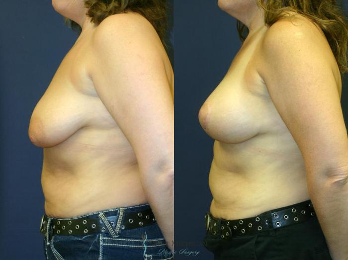 Before & After Breast Augmentation with Lift Case 8908 View #2 View in Kalamazoo & Grand Rapids, Michigan