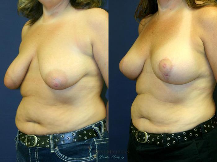 Before & After Breast Augmentation with Lift Case 8908 View #3 View in Kalamazoo & Grand Rapids, Michigan