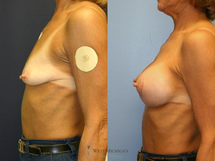 Before & After Breast Augmentation with Lift Case 8910 View #2 View in Portage, Kalamazoo, Battle Creek, Michigan